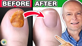 1 Absolute Best Toenail Fungus Cure [upl. by Reinal]