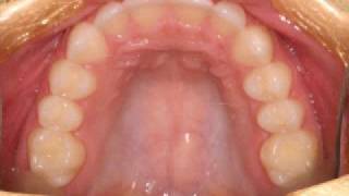 Invisalign OrthodonticsBefore amp AfterMick Family Dental [upl. by Piggy]