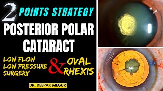 Posterior Polar Cataract My 2Point Strategy Low flow low pressure surgery amp Oval Rhexis Dr DM [upl. by Natsreik]