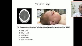 Case 134 hemorrhagi shock subgaleal hemorrhage SGH extra cranial bleeding cephalhematoma cap [upl. by Fezoj]