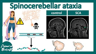 Spinocerebellar Ataxia  Pathology diagnosis and treatment of Spinocerebellar Ataxia  USMLE [upl. by Gregory]