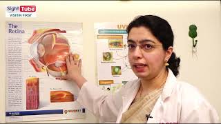 Uveitis and its treatment by Dr Abhilasha Baharani Neoretina Eyecare Institute Hyderabad [upl. by Tremayne]