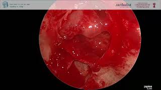 Resection of Pituitary Adenoma via transnasal transspheonidal approach Minimally Invasive Surgery [upl. by Eitnom]