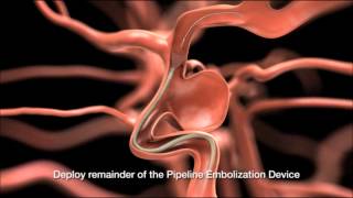 Flow Diverter Treatment of Brain Aneurysm [upl. by Par]