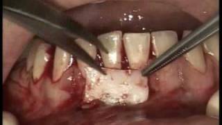 Implants Dentaires  Greffe gingivale libre [upl. by Nonnerb]