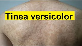 tinea versicolor treatment [upl. by Van]