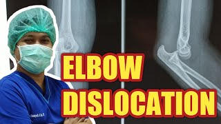 Kasus Ortopedi Dislokasi Sendi Siku Elbow Dislocation [upl. by Bradstreet]