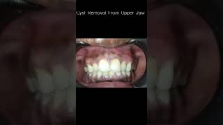 Periapical cyst treatment  Apicectomy done Teeth saved [upl. by Paquito548]