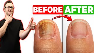 BEST Toenail Fungus Treatment 2024 4 BIG SECRETS [upl. by Nyladnarb]