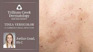 How to spot Tinea Versicolor a common fungal rash [upl. by Annait877]