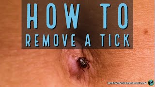 Tick Removal [upl. by Yecam]