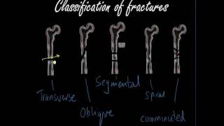 Classifying and presenting Fractures  Orthopaedics for Medical Students  Finals [upl. by Yrennalf46]