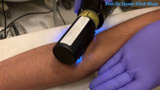 Can You LASER Away Vitiligo Patches Unveiling Power of Excimer 308 Laser Treatment laser vitiligo [upl. by Rehc]