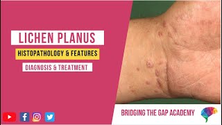 What is Lichen Planus Histopathology amp Features Diagnosis amp Treatment [upl. by Atterol]