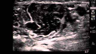 ultrasound guided musculocutaneous nerve block [upl. by Ecinev398]