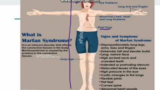 Marfan Syndrome [upl. by Honebein102]