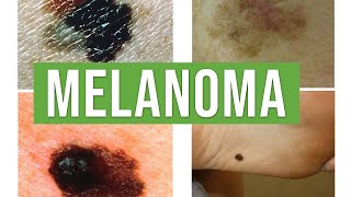 Melanoma vs Benign Melanocytic Nevus  Lecturio Dermatology [upl. by Fesuy]