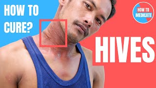 10 TIPS TO GET RID OF HIVES  Dermatologist DrDrayzday [upl. by Pirri279]