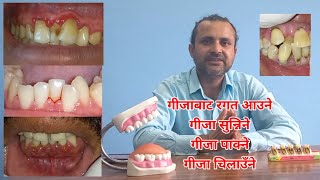 गीजाको समस्यामा कस्तो हुन्छ। Gum disease explained in Nepali [upl. by Omocaig]