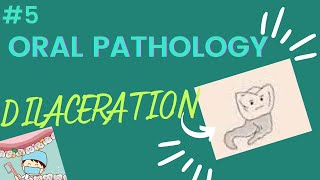 DILACERATION in dentistry [upl. by Guinn]