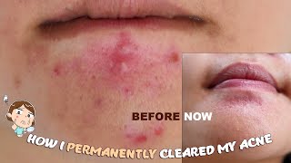 How I cleared by Hormonal Acne amp Scars [upl. by Rettuc494]