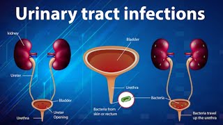 Understanding Urosepsis A 3D Animated Guide [upl. by Clite]