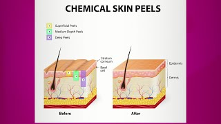 Chemical Peel Purpose amp Types [upl. by Chrissie]