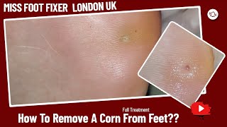 How To Remove a Corn From Feet  Foot Corn Full Treatment By Miss Foot Fixer [upl. by Meadows]