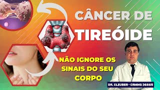 CÂNCER DE TIREÓIDE Conheça os Sintomas o Tratamento e a Cirurgia [upl. by Elsworth]