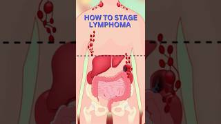 What is LYMPHOMA amp How to Stage it [upl. by Cavanaugh]