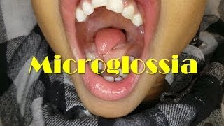 A Rare Case of Microglossia [upl. by Lars]