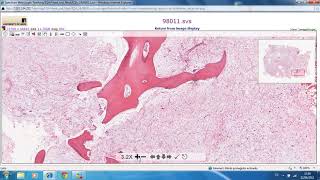 Odontogenic Myxoma Mixoma Odontogénico🔬odontogenictumors Myxoma [upl. by Froma]