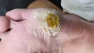 A big callus on the foot Clean up slowly【Joo Yidao】 [upl. by Anirahs909]