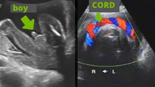 Ultrasound showing boy baby with umbilical cord around its neck [upl. by Nohshan]