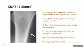 Approach to Ewings sarcoma By Dr Prabhat 31 12 2021 [upl. by Airahs]