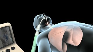 Intubation amp Mechanical Ventilation Ventilator [upl. by Thebault]