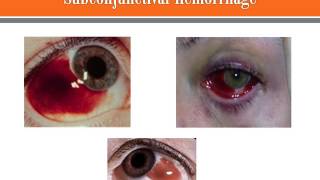 Subconjunctival Hemorrhage [upl. by Elenahc]