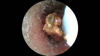 Insane Ear Wax Removal with Camera Tool [upl. by Aneerol161]