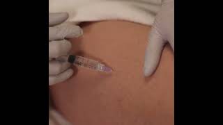 Mesotherapy  Injectables [upl. by Ailicec222]