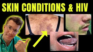 Doctor explains skin conditions associated with HIV  AIDS eg Kaposi sarcoma candida amp more [upl. by Shannon]