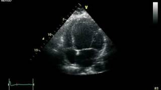 DCM  DILATED CARDIOMYOPATHY VIDEO [upl. by Teerpnam473]