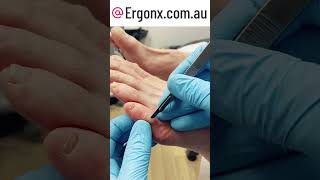 Painful corn on little toe removal by Australian podiatrist [upl. by Ahtenek]