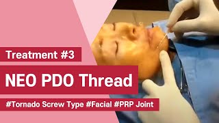 NeoGenesis Thread Series PDO Tornado Screw Type Facial Joint Procedure with PRP [upl. by Annahavas387]