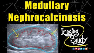 Medullary Nephrocalcinosis  Ultrasound  Case 128 [upl. by Noramac]