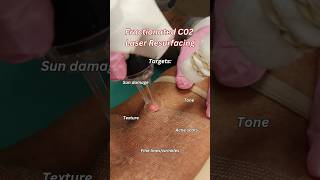 A look into co2 fractionated laser resurfacing laser co2laser skincare antiaging plasticsurgeon [upl. by Melleta]