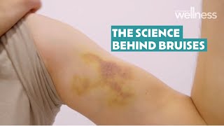 The science behind bruises [upl. by Kimura429]