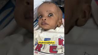 Hydrocephalus  ventricles of brain  normal pressure hydrocephalus  youtubeshorts [upl. by Nylaehs]