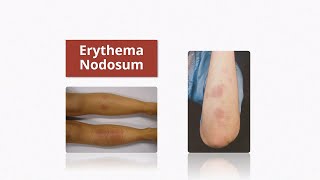 Erythema Nodosum  Causes amp Treatment [upl. by Natsirk]