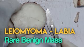 Leiomyoma  Labia Rare Benign Mass  Dissection essenceworld [upl. by Leur452]