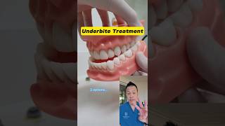 Transform Your Smile 3 Underbite Correction Options You Need to Know shorts dentallan [upl. by Trinette]